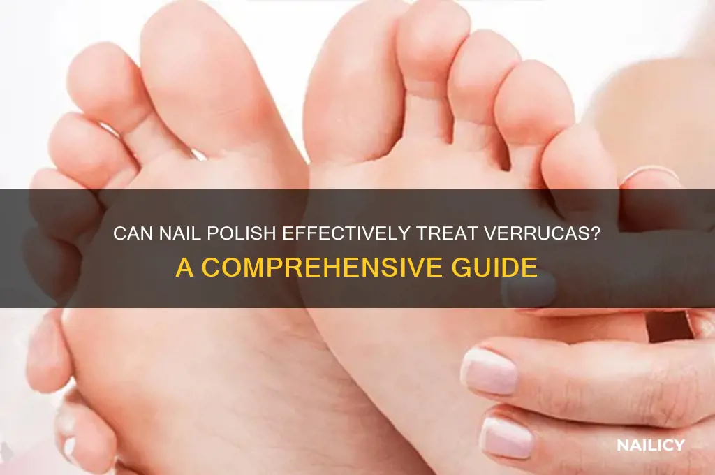 does nail polish work on verrucas