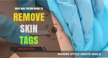 Nail Polish: An Effective Skin Tag Remover?