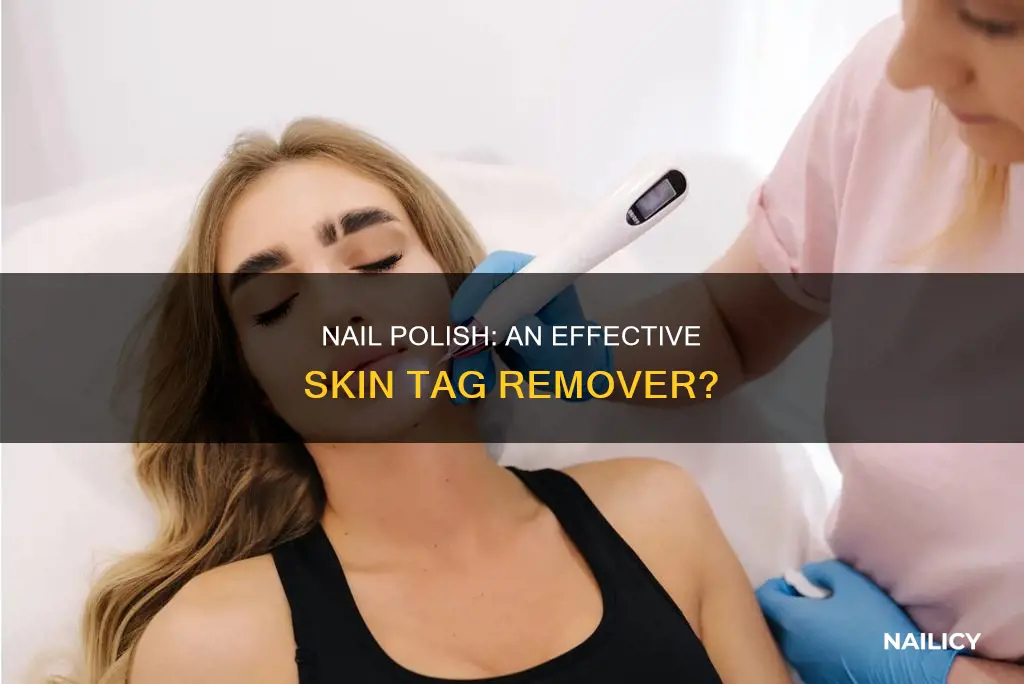 does nail polish work to remove skin tags