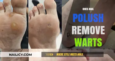 Nail Polish: Effective Wart Remover or Just a Myth?