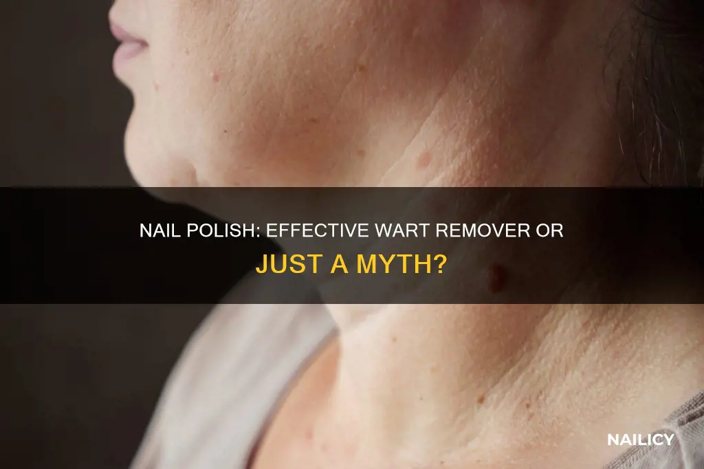 does nail polush remove warts