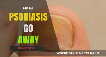 Can Nail Psoriasis Be Cured? Understanding Symptoms and Treatment Options