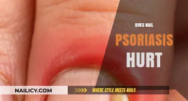 Does Nail Psoriasis Hurt? Understanding Pain and Discomfort in Nail Psoriasis