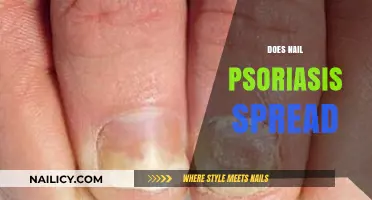 Does Nail Psoriasis Spread? Understanding Its Impact and Management