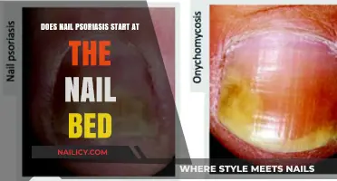 Does Nail Psoriasis Begin at the Nail Bed? Unveiling the Truth