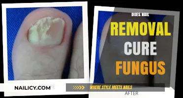 Nail Removal: Effective Treatment for Fungus?