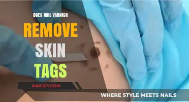 Nail Varnish: A Skin Tag Remover?