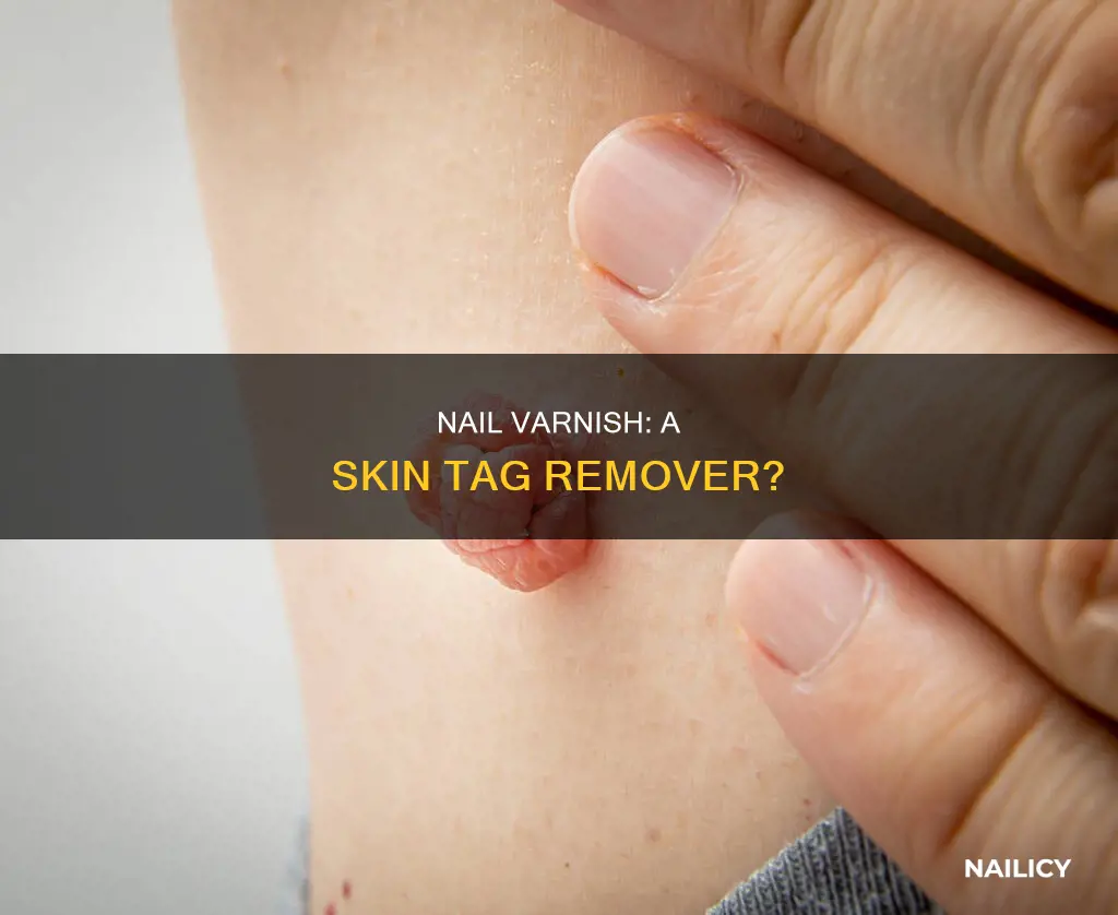 does nail varnish remove skin tags