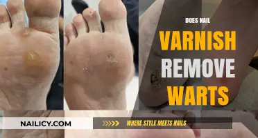 How Nail Varnish Can Remove Warts