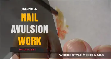 Does Partial Nail Avulsion Work? Exploring Effectiveness and Recovery Insights
