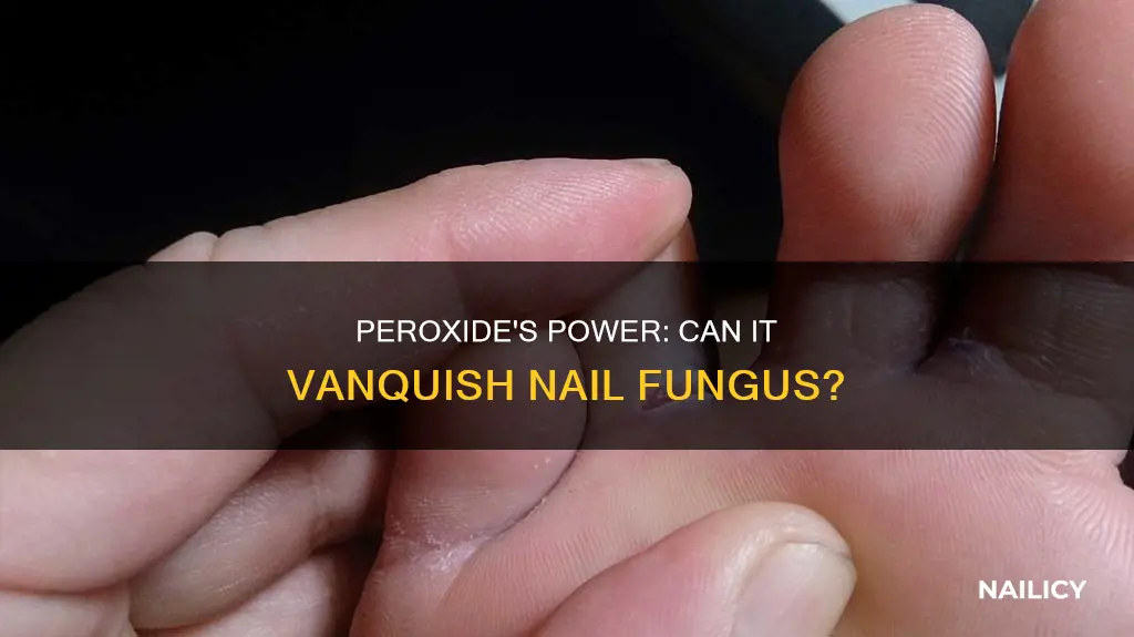 does peroxide kill finger nail fungus