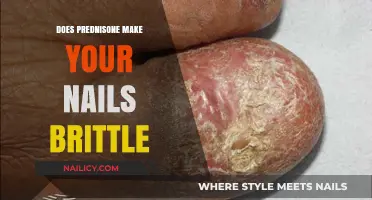 Prednisone Side Effects: Brittle Nails and More