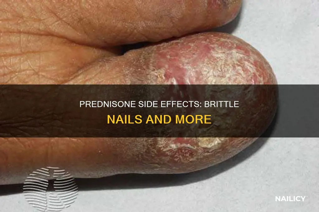 does prednisone make your nails brittle