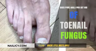 Toenail Fungus Treatment: Does Pure Nails Pro Really Work?