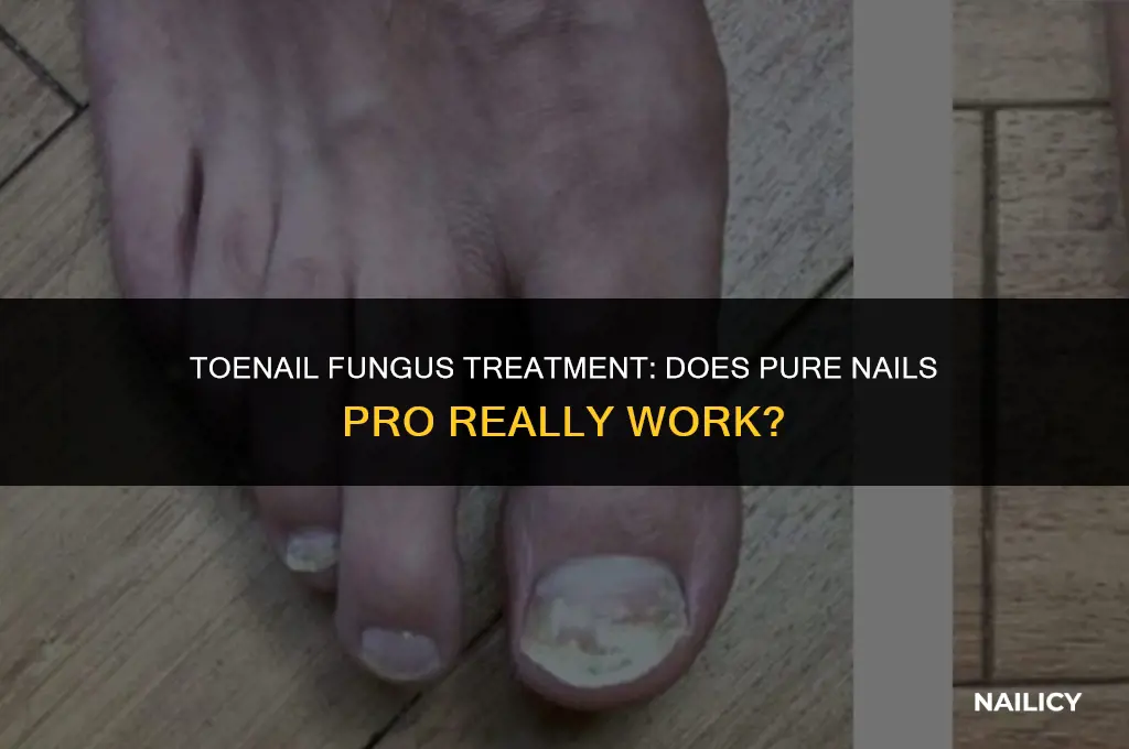 does pure nails pro get rid of toenail fungus