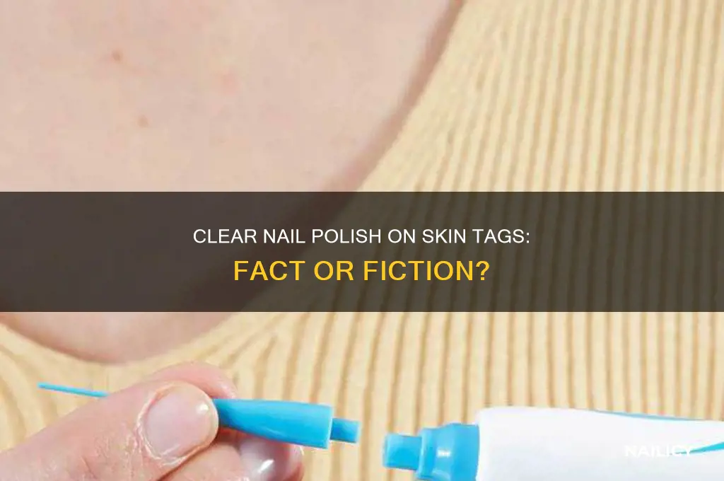 does putting clear nail polish on skin tags work