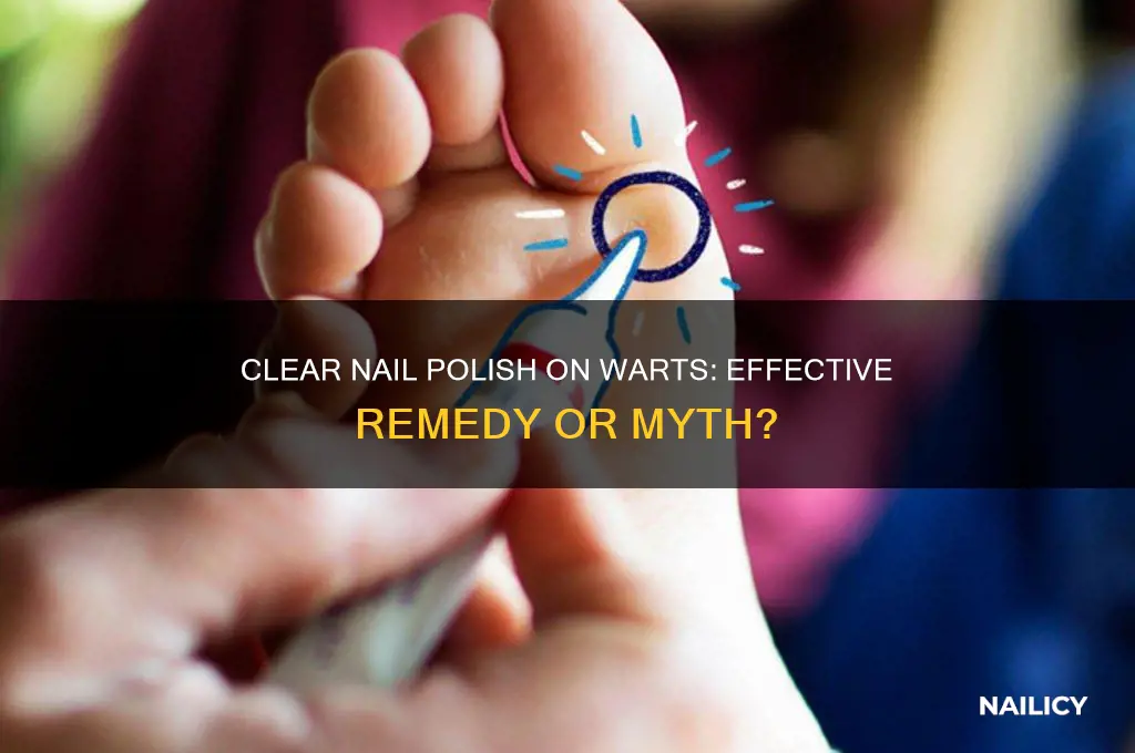 does putting clear nail polish on warts help