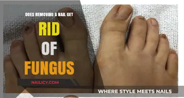 Nail Fungus Removal: Does Extracting the Nail Cure the Infection?