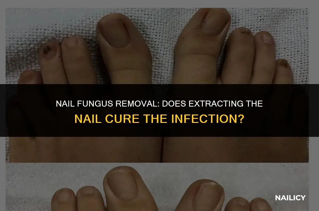 does removing a nail get rid of fungus