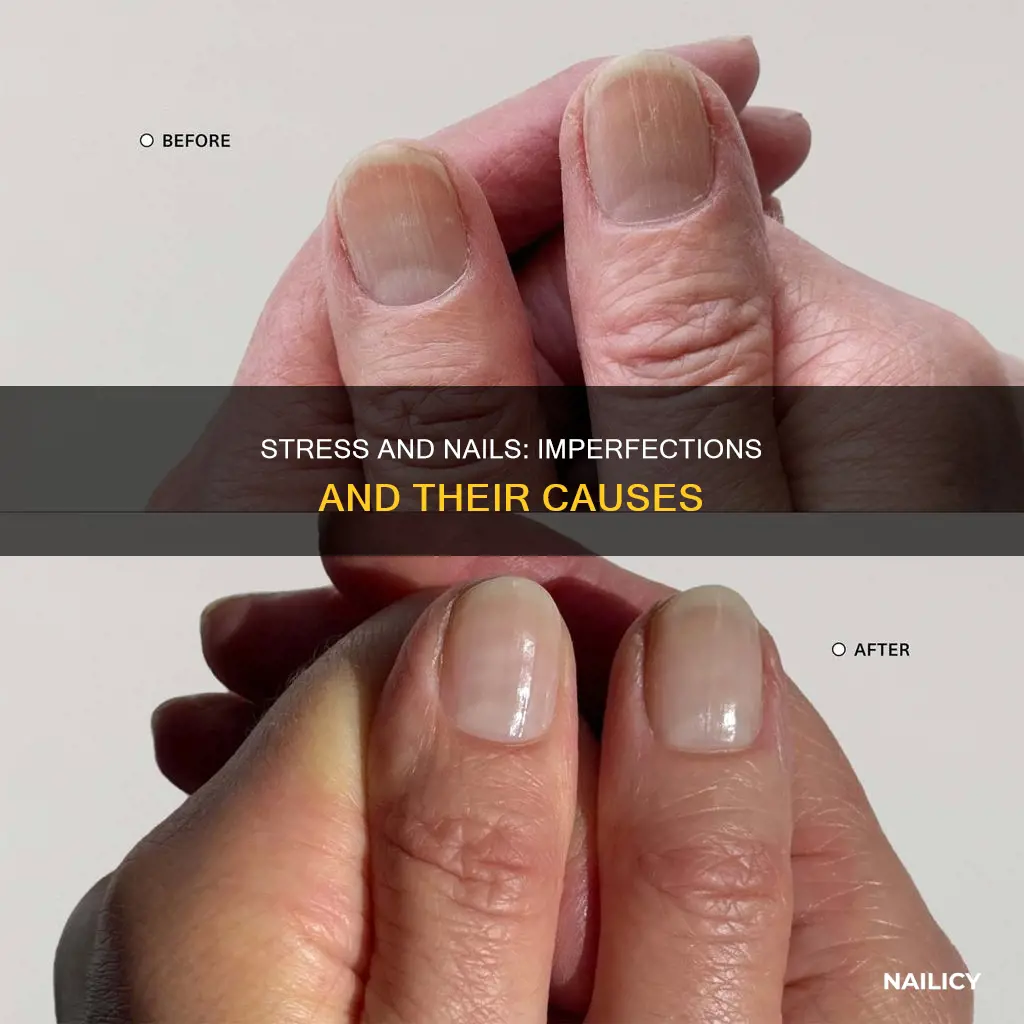 does stress cause finger nail imperfections