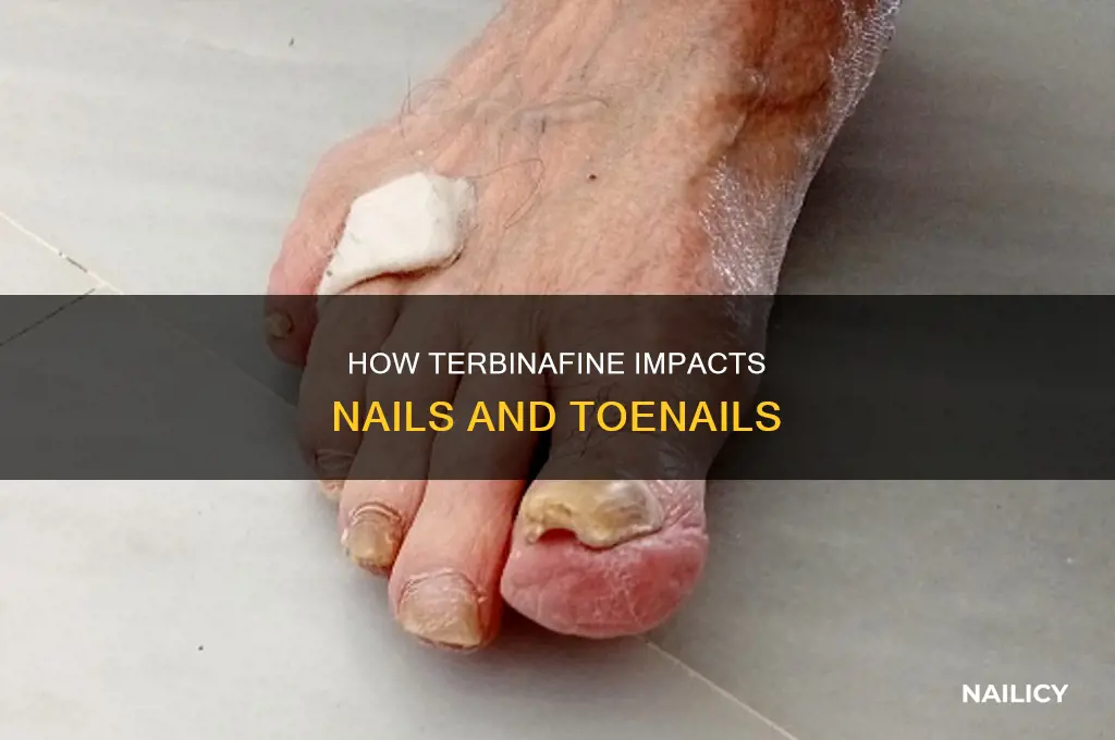 does terbinafine make your nail fall off