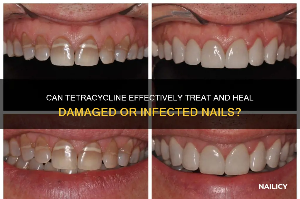 does tetracycline heal nails
