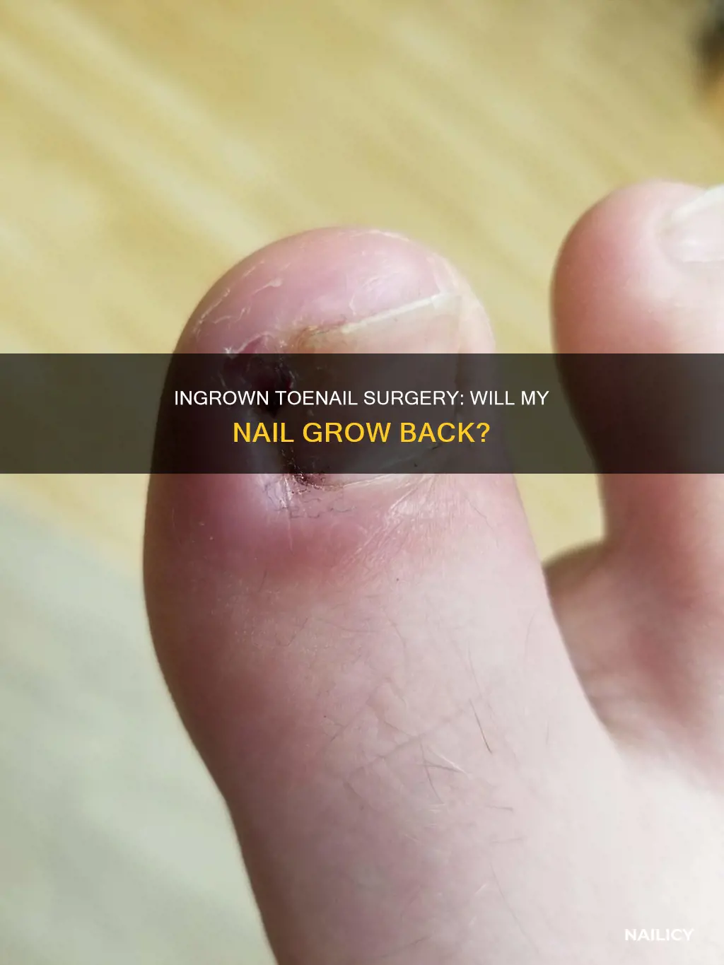 does the nail grow back after ingrown toenail surgery