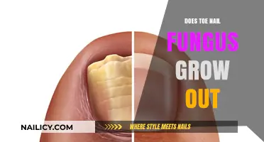 Toe Nail Fungus: Can You Grow It Out?