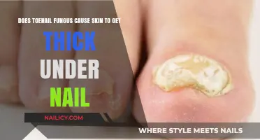 Understanding Toenail Fungus: Does It Cause Skin Thickening Under the Nail?