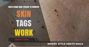 Nail Polish for Skin Tag Removal: Myth or Miracle?