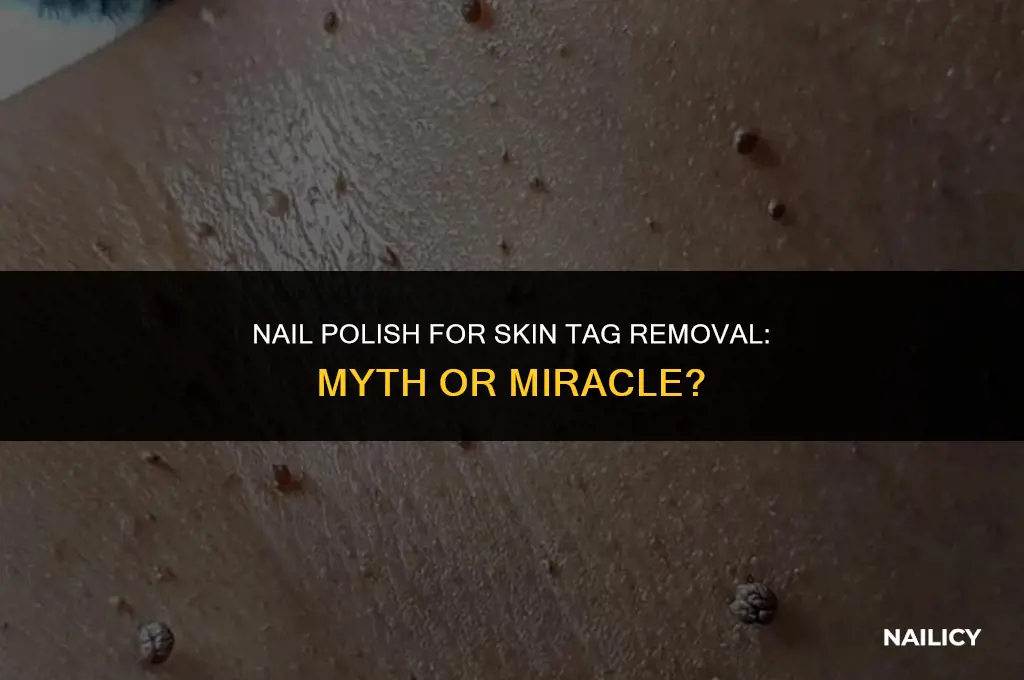 does using nail polish to remove skin tags work