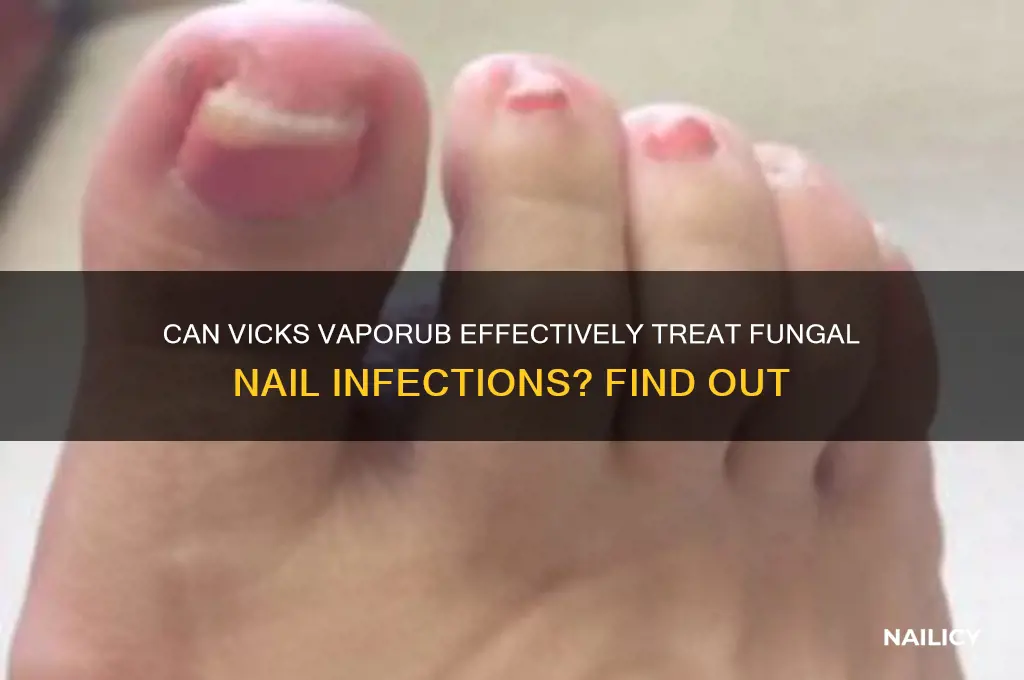 does vicks cure fungal nail