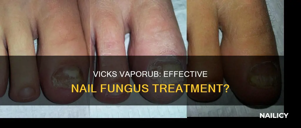 does vicks remove nail fungus