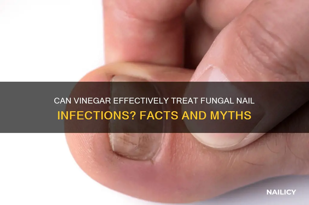 does vinegar cure fungal nail