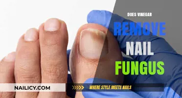 Vinegar Treatment for Nail Fungus: Does It Work?