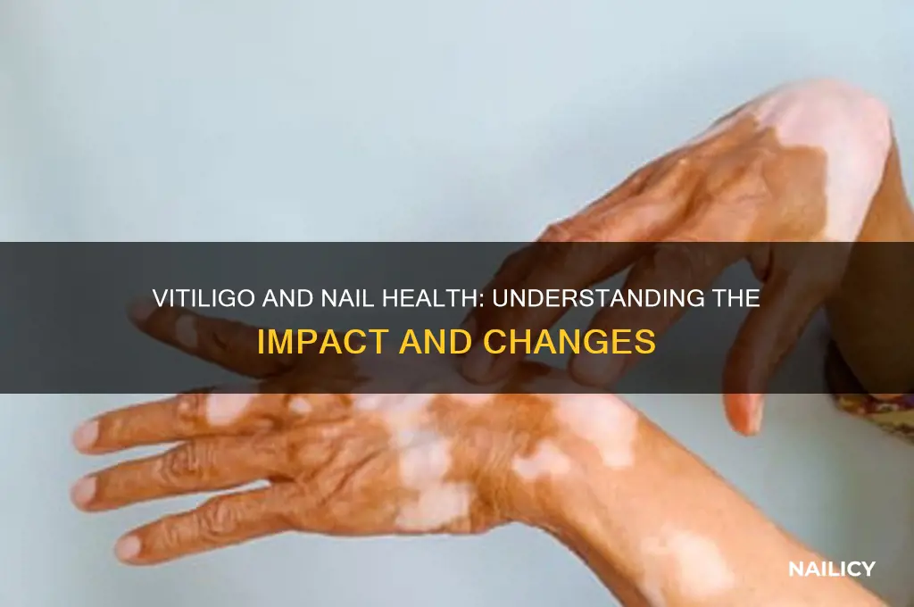 does vitiligo affect nails