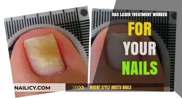 Laser Nail Treatment: Real Results or Just a Trend?
