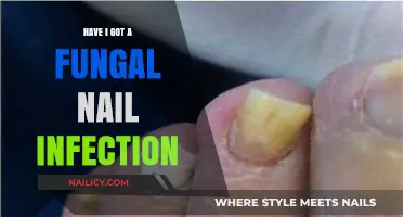 Identifying Fungal Nail Infections: Symptoms, Causes, and Treatment Options
