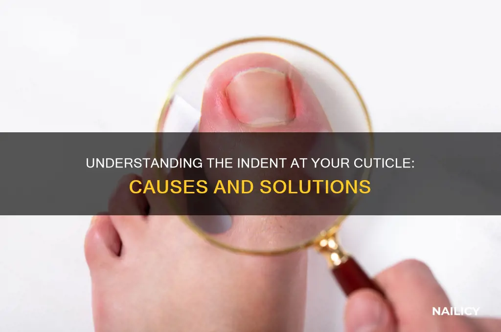 have indent in my nail at cuticle