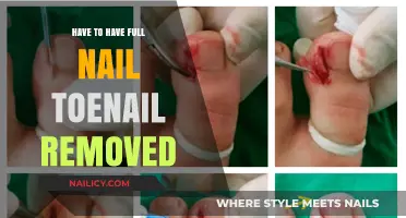 Toe Nail Removal: What to Expect