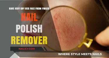 How to Soothe Dry, Red Skin from Nail Polish Remover
