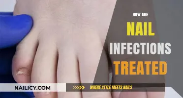 Effective Treatments for Nail Infections: Remedies and Prevention Tips