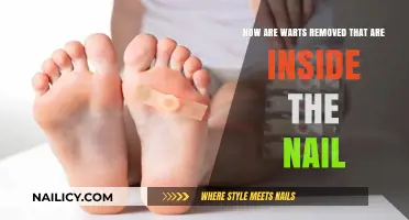 Effective Wart Removal: Inside the Nail
