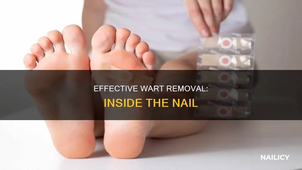 how are warts removed that are inside the nail
