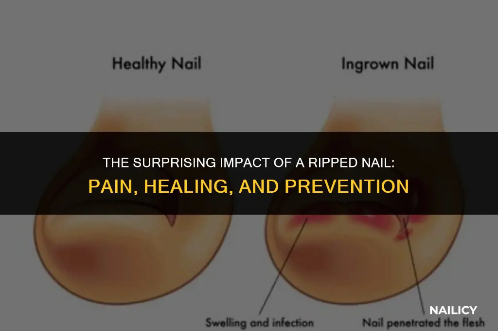how badly does getting your nail ripped off