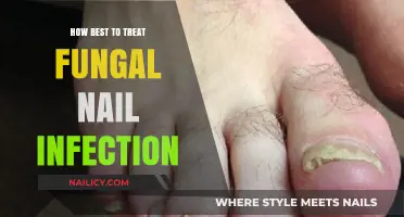 Effective Treatment Strategies for Overcoming Persistent Fungal Nail Infections