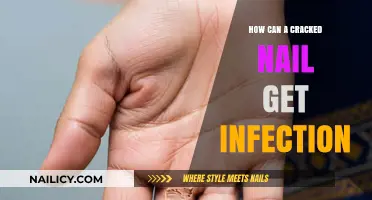 The Risks of Infection: Caring for a Cracked Nail