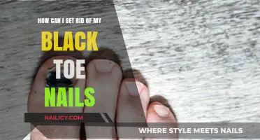 Banish Black Toenails: Effective Remedies for Healthy Feet