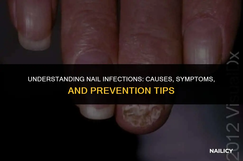 how can you get a nail infection
