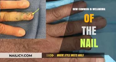 Melanoma of the Nail: Understanding Its Prevalence and Risks